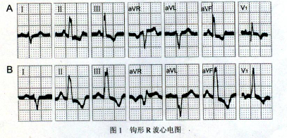 心电学一词一图讲解16------《钩形r波》