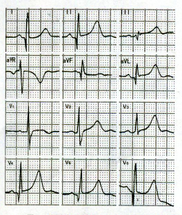 学术动态   少数急性心肌梗死病例,也可见到q波t波分离现象,其有病理
