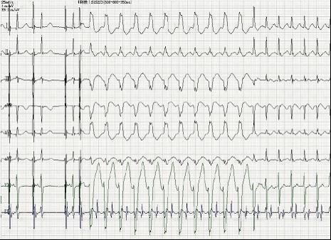 《食管心脏电生理》第二十七讲-房室折返性心动过速(二)